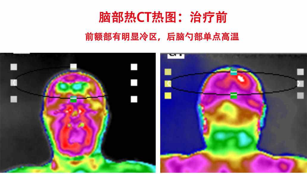 3分钟让你看懂亚星平台的“脑部热CT”热图解读！